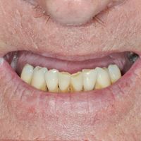Smile In A Day - 14 before